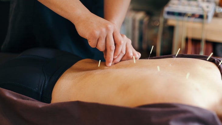 acupuncture-session-in-a-japanese-medical-study-picture-id653494054 None